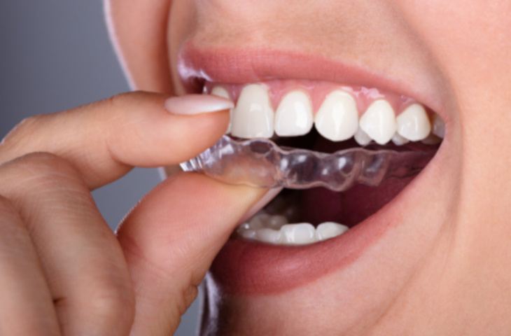 Clear Aligners / Invisalign in Chicago